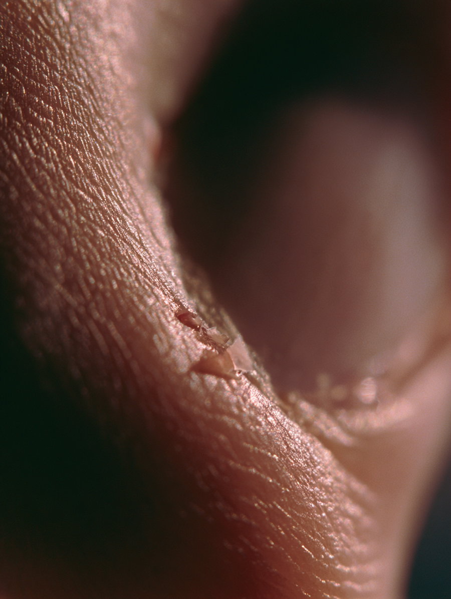 Close-up photograph showing textured dry skin with peeling flakes near a fingernail, highlighting skin creases and dryness